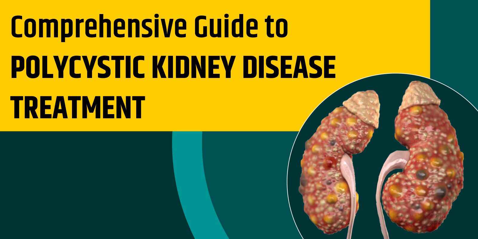 Comprehensive Guide to Polycystic Kidney Disease Treatment